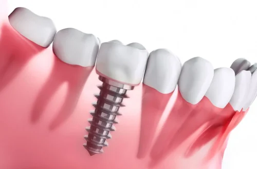 How Dental Implants Facilitate Better Oral Hygiene Compared to Traditional Bridges
