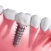How Dental Implants Facilitate Better Oral Hygiene Compared to Traditional Bridges